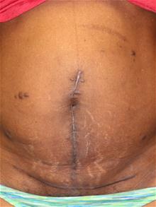 Scar Revision After Photo by Laurence Glickman, MD, MSc, FRCS(c),  FACS; Garden City, NY - Case 28005