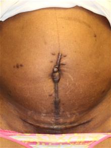 Scar Revision Before Photo by Laurence Glickman, MD, MSc, FRCS(c),  FACS; Garden City, NY - Case 28005