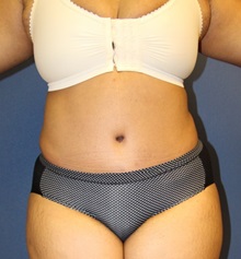 Tummy Tuck After Photo by Laurence Glickman, MD, MSc, FRCS(c),  FACS; Garden City, NY - Case 28575