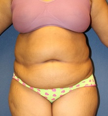 Tummy Tuck Before Photo by Laurence Glickman, MD, MSc, FRCS(c),  FACS; Garden City, NY - Case 28575
