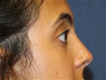 Eyelid Surgery After Photo by Laurence Glickman, MD, MSc, FRCS(c),  FACS; Garden City, NY - Case 28576
