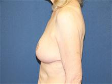 Breast Lift After Photo by Laurence Glickman, MD, MSc, FRCS(c),  FACS; Garden City, NY - Case 28577