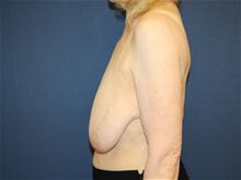 Breast Lift Before Photo by Laurence Glickman, MD, MSc, FRCS(c),  FACS; Garden City, NY - Case 28577