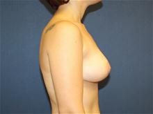 Breast Lift After Photo by Laurence Glickman, MD, MSc, FRCS(c),  FACS; Garden City, NY - Case 28579