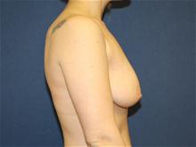 Breast Lift Before Photo by Laurence Glickman, MD, MSc, FRCS(c),  FACS; Garden City, NY - Case 28579