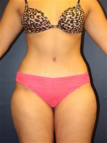 Tummy Tuck After Photo by Laurence Glickman, MD, MSc, FRCS(c),  FACS; Garden City, NY - Case 28580