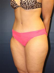 Tummy Tuck After Photo by Laurence Glickman, MD, MSc, FRCS(c),  FACS; Garden City, NY - Case 28580