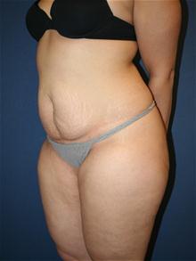 Tummy Tuck Before Photo by Laurence Glickman, MD, MSc, FRCS(c),  FACS; Garden City, NY - Case 28580