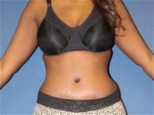 Tummy Tuck After Photo by Laurence Glickman, MD, MSc, FRCS(c),  FACS; Garden City, NY - Case 28581