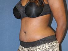 Tummy Tuck After Photo by Laurence Glickman, MD, MSc, FRCS(c),  FACS; Garden City, NY - Case 28581
