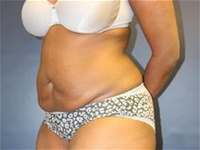 Tummy Tuck Before Photo by Laurence Glickman, MD, MSc, FRCS(c),  FACS; Garden City, NY - Case 28581