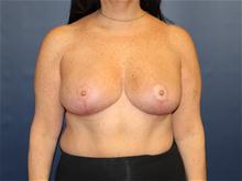 Breast Reduction After Photo by Laurence Glickman, MD, MSc, FRCS(c),  FACS; Garden City, NY - Case 28582