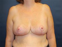 Breast Reduction After Photo by Laurence Glickman, MD, MSc, FRCS(c),  FACS; Garden City, NY - Case 28583
