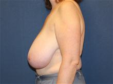 Breast Reduction Before Photo by Laurence Glickman, MD, MSc, FRCS(c),  FACS; Garden City, NY - Case 28583