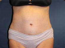 Tummy Tuck After Photo by Laurence Glickman, MD, MSc, FRCS(c),  FACS; Garden City, NY - Case 28584