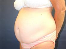Tummy Tuck Before Photo by Laurence Glickman, MD, MSc, FRCS(c),  FACS; Garden City, NY - Case 28584