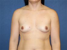 Breast Augmentation Before Photo by Laurence Glickman, MD, MSc, FRCS(c),  FACS; Garden City, NY - Case 28585