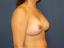 Breast Augmentation After Photo by Laurence Glickman, MD, MSc, FRCS(c),  FACS; Garden City, NY - Case 28585