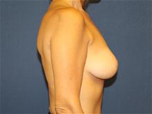 Breast Lift After Photo by Laurence Glickman, MD, MSc, FRCS(c),  FACS; Garden City, NY - Case 28587