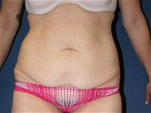 Body Contouring Before Photo by Laurence Glickman, MD, MSc, FRCS(c),  FACS; Garden City, NY - Case 28588
