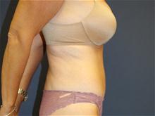 Body Contouring After Photo by Laurence Glickman, MD, MSc, FRCS(c),  FACS; Garden City, NY - Case 28588