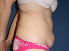Body Contouring Before Photo by Laurence Glickman, MD, MSc, FRCS(c),  FACS; Garden City, NY - Case 28588
