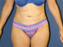 Liposuction After Photo by Laurence Glickman, MD, MSc, FRCS(c),  FACS; Garden City, NY - Case 28589