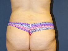 Liposuction After Photo by Laurence Glickman, MD, MSc, FRCS(c),  FACS; Garden City, NY - Case 28589