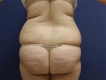 Liposuction Before Photo by Laurence Glickman, MD, MSc, FRCS(c),  FACS; Garden City, NY - Case 28589