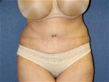 Tummy Tuck After Photo by Laurence Glickman, MD, MSc, FRCS(c),  FACS; Garden City, NY - Case 28590