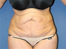 Tummy Tuck Before Photo by Laurence Glickman, MD, MSc, FRCS(c),  FACS; Garden City, NY - Case 28590