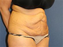 Tummy Tuck Before Photo by Laurence Glickman, MD, MSc, FRCS(c),  FACS; Garden City, NY - Case 28590