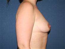 Breast Augmentation Before Photo by Laurence Glickman, MD, MSc, FRCS(c),  FACS; Garden City, NY - Case 28591