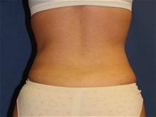 Liposuction After Photo by Laurence Glickman, MD, MSc, FRCS(c),  FACS; Garden City, NY - Case 28592