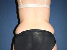 Liposuction Before Photo by Laurence Glickman, MD, MSc, FRCS(c),  FACS; Garden City, NY - Case 28592