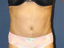 Tummy Tuck After Photo by Laurence Glickman, MD, MSc, FRCS(c),  FACS; Garden City, NY - Case 28593