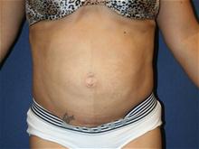 Tummy Tuck Before Photo by Laurence Glickman, MD, MSc, FRCS(c),  FACS; Garden City, NY - Case 28593