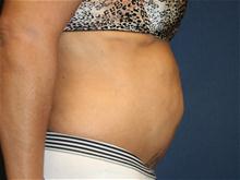 Tummy Tuck Before Photo by Laurence Glickman, MD, MSc, FRCS(c),  FACS; Garden City, NY - Case 28593