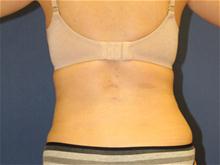 Liposuction After Photo by Laurence Glickman, MD, MSc, FRCS(c),  FACS; Garden City, NY - Case 28609