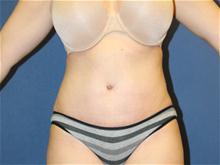 Tummy Tuck After Photo by Laurence Glickman, MD, MSc, FRCS(c),  FACS; Garden City, NY - Case 28611