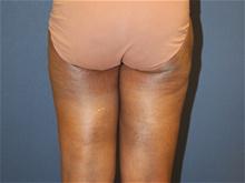 Liposuction After Photo by Laurence Glickman, MD, MSc, FRCS(c),  FACS; Garden City, NY - Case 28615