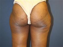 Liposuction Before Photo by Laurence Glickman, MD, MSc, FRCS(c),  FACS; Garden City, NY - Case 28615