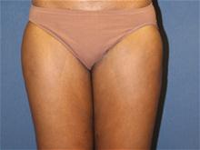 Liposuction After Photo by Laurence Glickman, MD, MSc, FRCS(c),  FACS; Garden City, NY - Case 28615