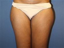 Liposuction Before Photo by Laurence Glickman, MD, MSc, FRCS(c),  FACS; Garden City, NY - Case 28615