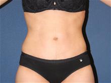 Tummy Tuck After Photo by Laurence Glickman, MD, MSc, FRCS(c),  FACS; Garden City, NY - Case 29086