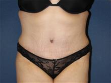 Tummy Tuck After Photo by Laurence Glickman, MD, MSc, FRCS(c),  FACS; Garden City, NY - Case 29087