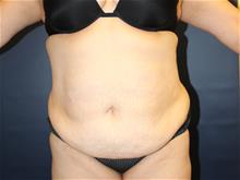 Tummy Tuck Before Photo by Laurence Glickman, MD, MSc, FRCS(c),  FACS; Garden City, NY - Case 29087