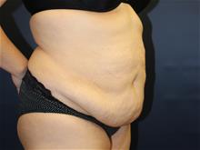 Tummy Tuck Before Photo by Laurence Glickman, MD, MSc, FRCS(c),  FACS; Garden City, NY - Case 29087