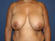 Breast Reduction Before Photo by Laurence Glickman, MD, MSc, FRCS(c),  FACS; Garden City, NY - Case 29117