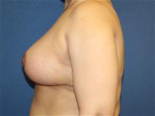 Breast Reduction After Photo by Laurence Glickman, MD, MSc, FRCS(c),  FACS; Garden City, NY - Case 29117